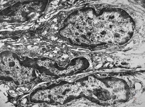 F,41y. | synovial metaplasia - capsule of implantate F,41y. | synovial metaplasia - capsule of implantate